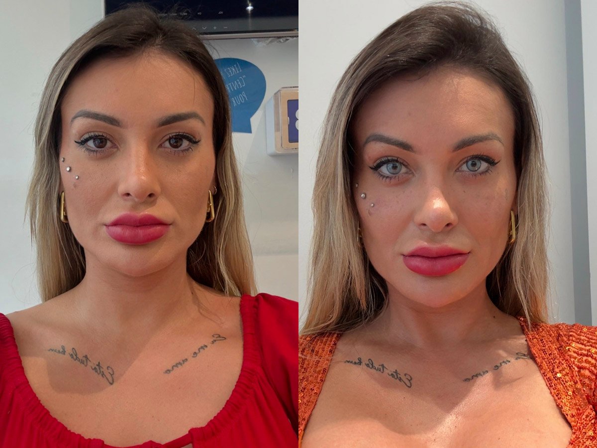 Andressa Urach segue os passos de Maya e muda cor dos olhos com cirurgia: “Sonho”