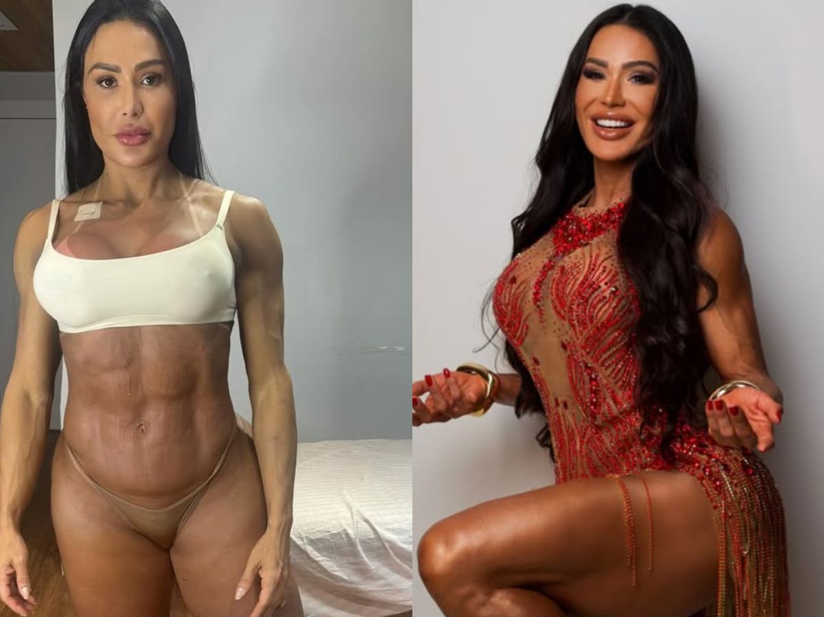 Gracyanne mostra antes e depois e explica ganho de 20 kg na balança após cirurgia